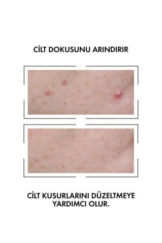Vichy Normaderm Leke Karşıtı Serum 30 ml + Normaderm Phytosolution Arındırıcı Jel 50 ml Hediye